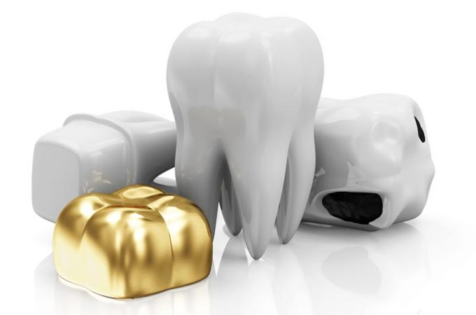 Common Dental Crown Materials and Their Benefits