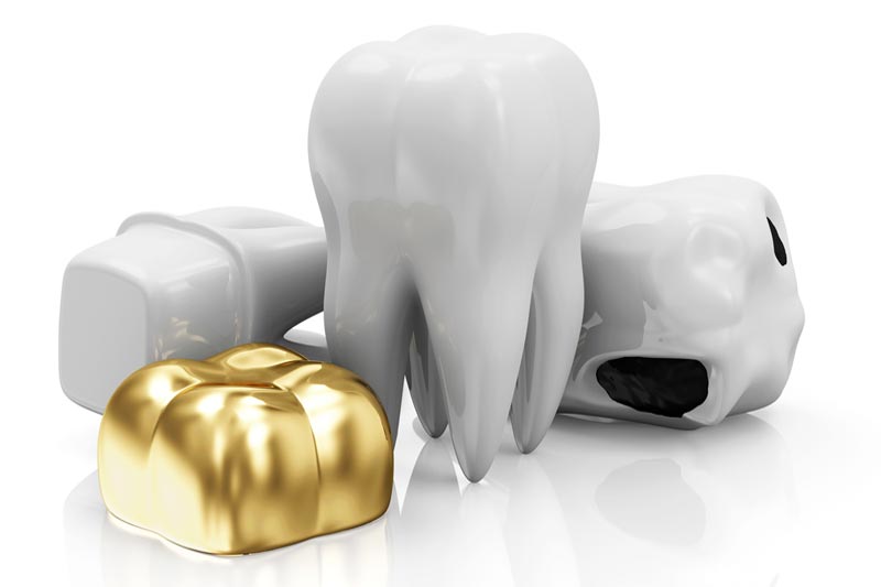 Dental Crown Materials