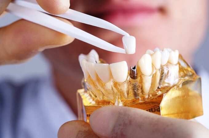 7 Reasons Why Dental Implants Might Be Suitable For You